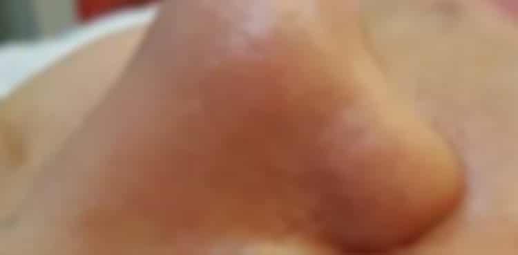 a close up of a nose after treatment