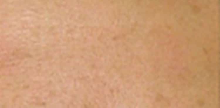 after treatment