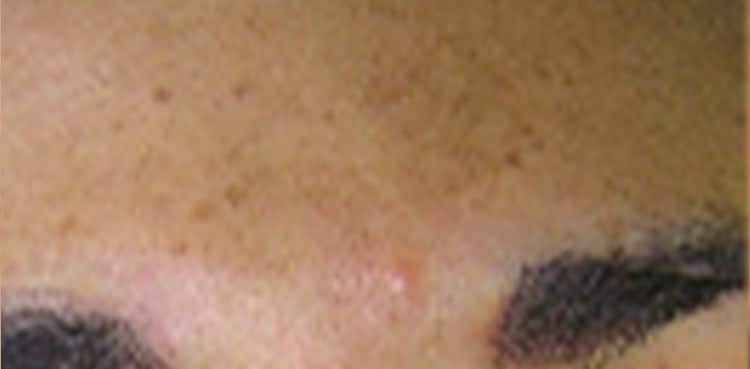 before treatment