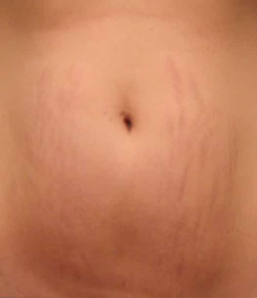 stretch marks on a belly after Stemfacial