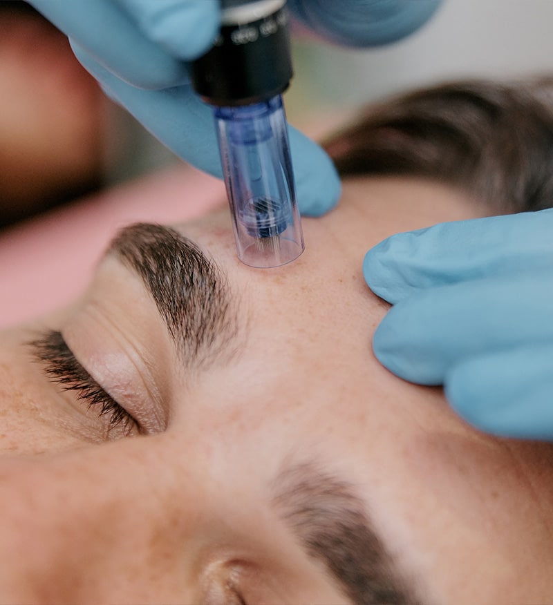 Aesthetic professional performing microneedling on a person's forehead